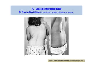 A. Escoliose toracolombar
B. Espondilolistese ( a seta indica a deformidade em degrau).
Reider, O Exame Físico em Ortopedia – Guanabara Koogan -2001
 