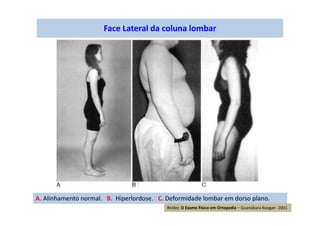 Face Lateral da coluna lombar
A. Alinhamento normal. B. Hiperlordose. C. Deformidade lombar em dorso plano.
Reider, O Exame Físico em Ortopedia – Guanabara Koogan -2001
 