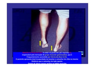 08/12/2015 Dr. José Heitor M. Fernandes 425
(Marcha na Ponta dos pés) O andar na ponta dos pés requisita S1,
responsável pela inervação do grupo muscular gastrossolear, que é
Frequentemente acometido por hérnia do disco L5-S1.
O paciente apresenta total incapacidade de levantar o calcanhar do chão na mesma
Distância que o calcanhar do lado oposto.
Depois de alguns passos verifica-se fadiga muscular.
 