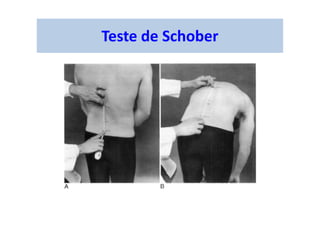 Teste de Schober
 