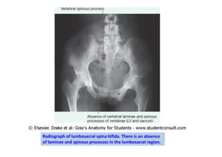 Radiograph of lumbosacral spina bifida. There is an absence
of laminae and spinous processes in the lumbosacral region.
 