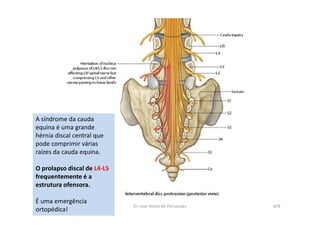 08/12/2015 Dr. José Heitor M. Fernandes 476
A síndrome da cauda
equina é uma grande
hérnia discal central que
pode comprimir várias
raízes da cauda equina.
O prolapso discal de L4-L5
frequentemente é a
estrutura ofensora.
É uma emergência
ortopédica!
 