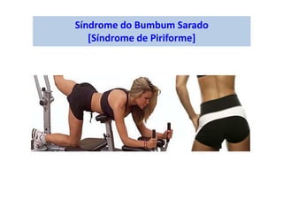 Síndrome do Bumbum Sarado
[Síndrome de Piriforme]
 