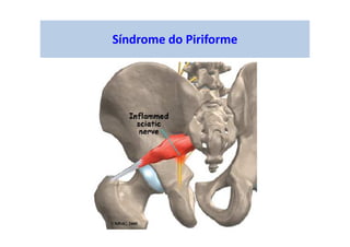 Síndrome do Piriforme
 