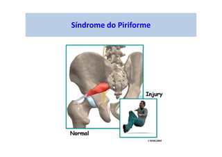 Síndrome do Piriforme
 