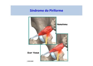 Síndrome do Piriforme
 