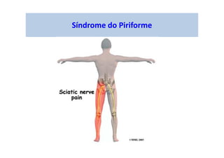 Síndrome do Piriforme
 