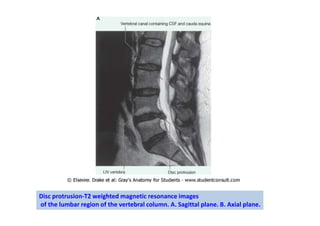 Disc protrusion-T2 weighted magnetic resonance images
of the lumbar region of the vertebral column. A. Sagittal plane. B. Axial plane.
 