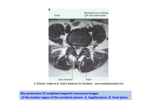 Disc protrusion-T2 weighted magnetic resonance images
of the lumbar region of the vertebral column. A. Sagittal plane. B. Axial plane.
 