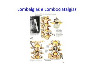 Lombalgias e Lombociatalgias
 