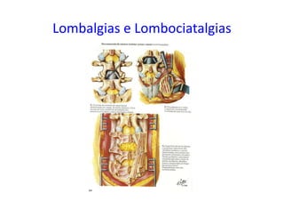 Lombalgias e Lombociatalgias
 