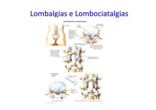 Lombalgias e Lombociatalgias
 