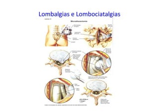 Lombalgias e Lombociatalgias
 