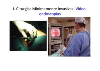 I. Cirurgias Minimamente Invasivas -Vídeo-
endoscopias
 