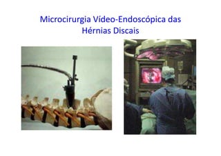 Microcirurgia Vídeo-Endoscópica das
Hérnias Discais
 