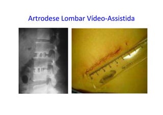 Artrodese Lombar Vídeo-Assistida
 