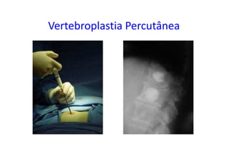 Vertebroplastia Percutânea
 