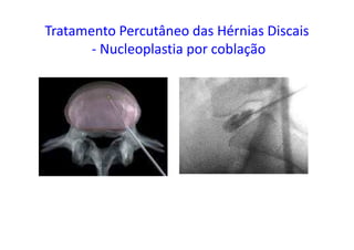 Tratamento Percutâneo das Hérnias Discais
- Nucleoplastia por coblação
 