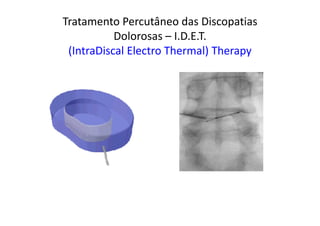 Tratamento Percutâneo das Discopatias
Dolorosas – I.D.E.T.
(IntraDiscal Electro Thermal) Therapy
 