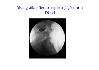 Discografia e Terapias por Injeção Intra-
Discal
 