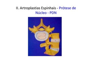II. Artroplastias Espinhais - Prótese de
Núcleo - PDN
 