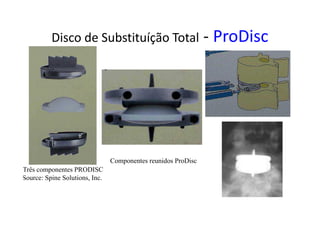 Disco de Substituíção Total - ProDisc
Três componentes PRODISC
Source: Spine Solutions, Inc.
Componentes reunidos ProDisc
 