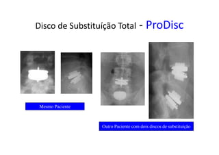 Disco de Substituíção Total - ProDisc
Mesmo Paciente
Outro Paciente com dois discos de substituíção
 