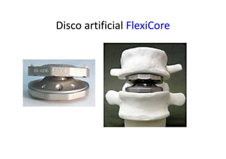 Disco artificial FlexiCore
 