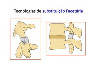Tecnologias de substituíção Facetária
 