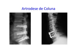 Artrodese de Coluna
 