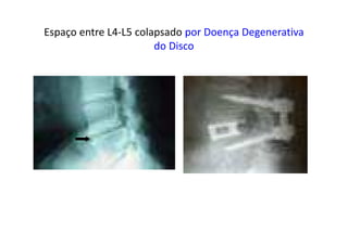Espaço entre L4-L5 colapsado por Doença Degenerativa
do Disco
 
