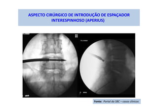 ASPECTO CIRÚRGICO DE INTRODUÇÃO DE ESPAÇADOR
INTERESPINHOSO (APERIUS)
Fonte: Portal da SBC – casos clínicos
 