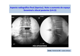 Aspecto radiográfico final (Aperius). Note o aumento do espaço
foraminal e discal posterior (L4-L5)
Fonte: Portal da SBC – casos clínicos
 