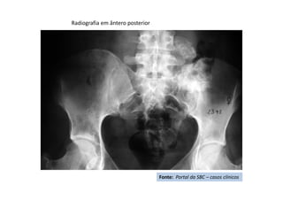 Radiografia em ântero posterior
Fonte: Portal da SBC – casos clínicos
 