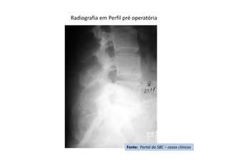 Radiografia em Perfil pré operatória
Fonte: Portal da SBC – casos clínicos
 