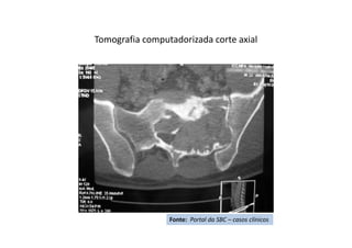 Tomografia computadorizada corte axial
Fonte: Portal da SBC – casos clínicos
 