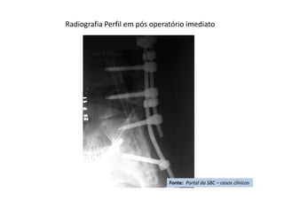 Radiografia Perfil em pós operatório imediato
Fonte: Portal da SBC – casos clínicos
 