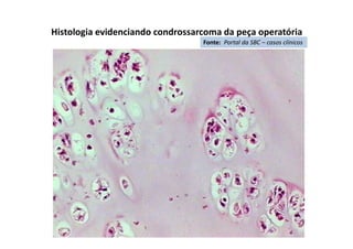 Histologia evidenciando condrossarcoma da peça operatória
Fonte: Portal da SBC – casos clínicos
 