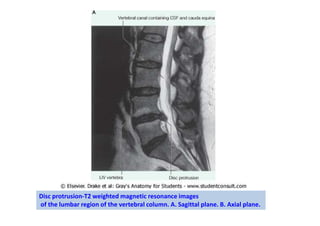 Disc protrusion-T2 weighted magnetic resonance images
of the lumbar region of the vertebral column. A. Sagittal plane. B. Axial plane.
 