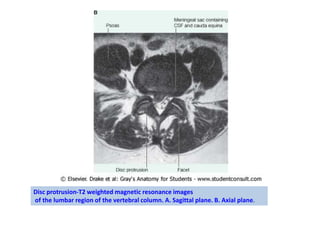 Disc protrusion-T2 weighted magnetic resonance images
of the lumbar region of the vertebral column. A. Sagittal plane. B. Axial plane.
 
