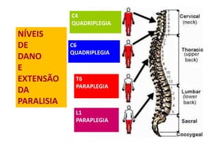 C4
QUADRIPLEGIA
C6
QUADRIPLEGIA
T6
PARAPLEGIA
L1
PARAPLEGIA
NÍVEIS
DE
DANO
E
EXTENSÃO
DA
PARALISIA
 