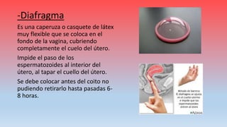 -Diafragma
Es una caperuza o casquete de látex
muy flexible que se coloca en el
fondo de la vagina, cubriendo
completamente el cuelo del útero.
Impide el paso de los
espermatozoides al interior del
útero, al tapar el cuello del útero.
Se debe colocar antes del coito no
pudiendo retirarlo hasta pasadas 6-
8 horas.
 