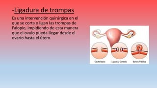 -Ligadura de trompas
Es una intervención quirúrgica en el
que se corta o ligan las trompas de
Falopio, impidiendo de esta manera
que el ovulo pueda llegar desde el
ovario hasta el útero.
 