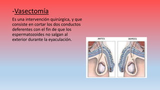 -Vasectomía
Es una intervención quirúrgica, y que
consiste en cortar los dos conductos
deferentes con el fin de que los
espermatozoides no salgan al
exterior durante la eyaculación.
 