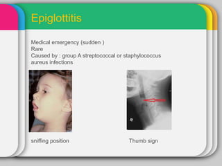Epiglottitis
Medical emergency (sudden )
Rare
Caused by : group A streptococcal or staphylococcus
aureus infections
sniffing position Thumb sign
 