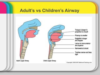 Adult’s vs Children’s Airway
 