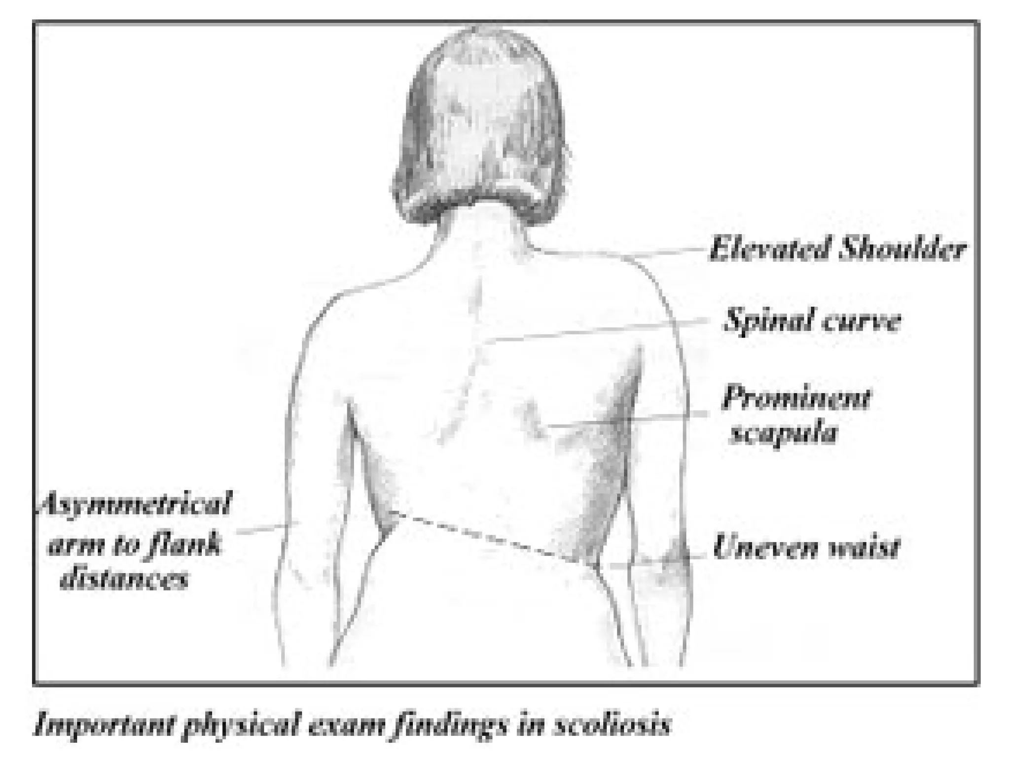 ub-hsped-scoliosis-differential-dx-functional-and-structural-scoliosis.pdf
