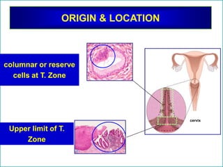 ORIGIN & LOCATION
columnar or reserve
cells at T. Zone
Upper limit of T.
Zone
cervix
 