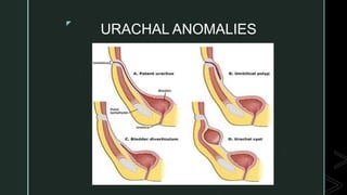 z
URACHAL ANOMALIES
 