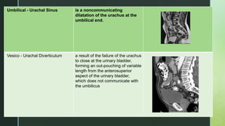 z
Umbilical - Urachal Sinus is a noncommunicating
dilatation of the urachus at the
umbilical end.
Vesico - Urachal Diverticulum a result of the failure of the urachus
to close at the urinary bladder,
forming an out-pouching of variable
length from the anterosuperior
aspect of the urinary bladder,
which does not communicate with
the umbilicus
 
